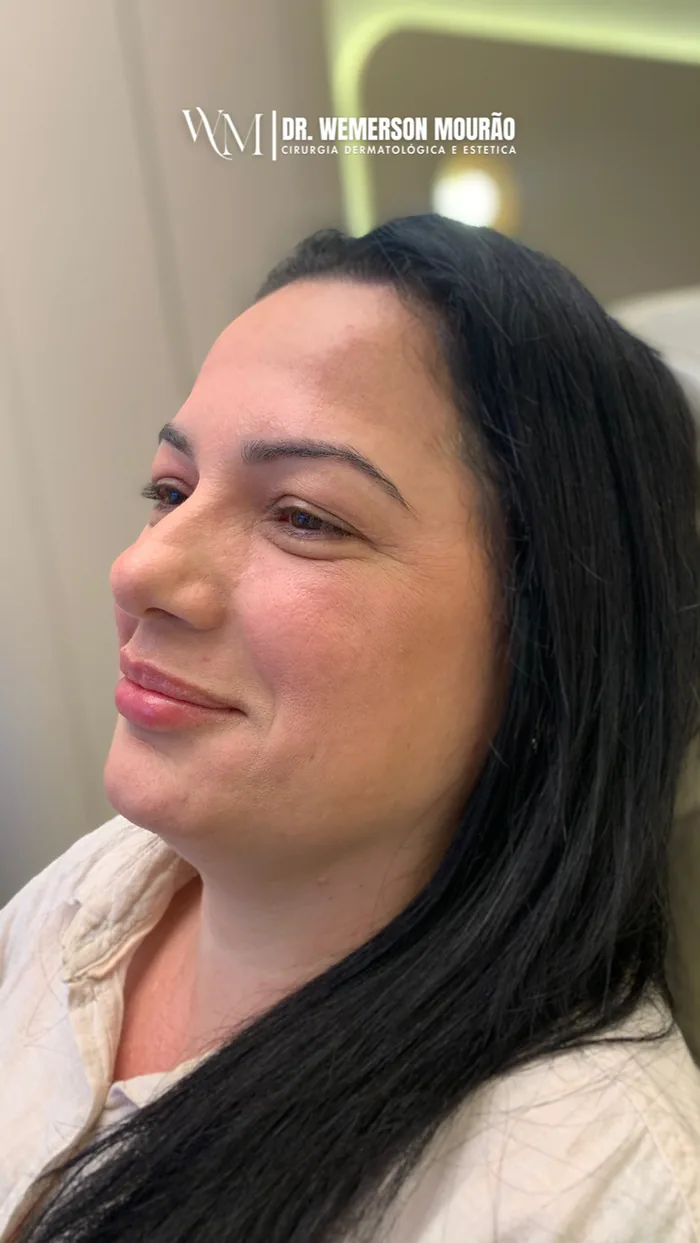 Blefaroplastia superior, antes