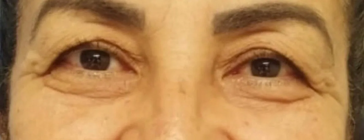 Blefaroplastia superior, antes