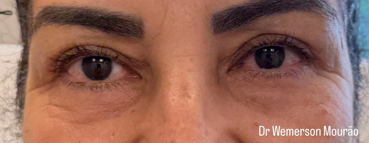 Blefaroplastia superior, depois