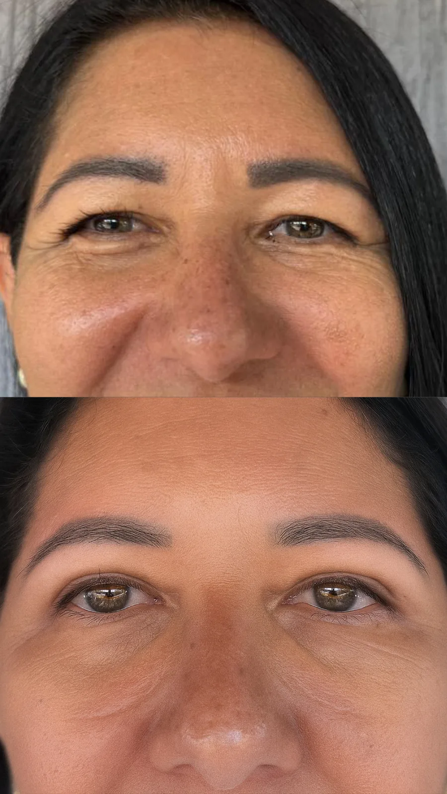 Blefaroplastia superior, antes e depois