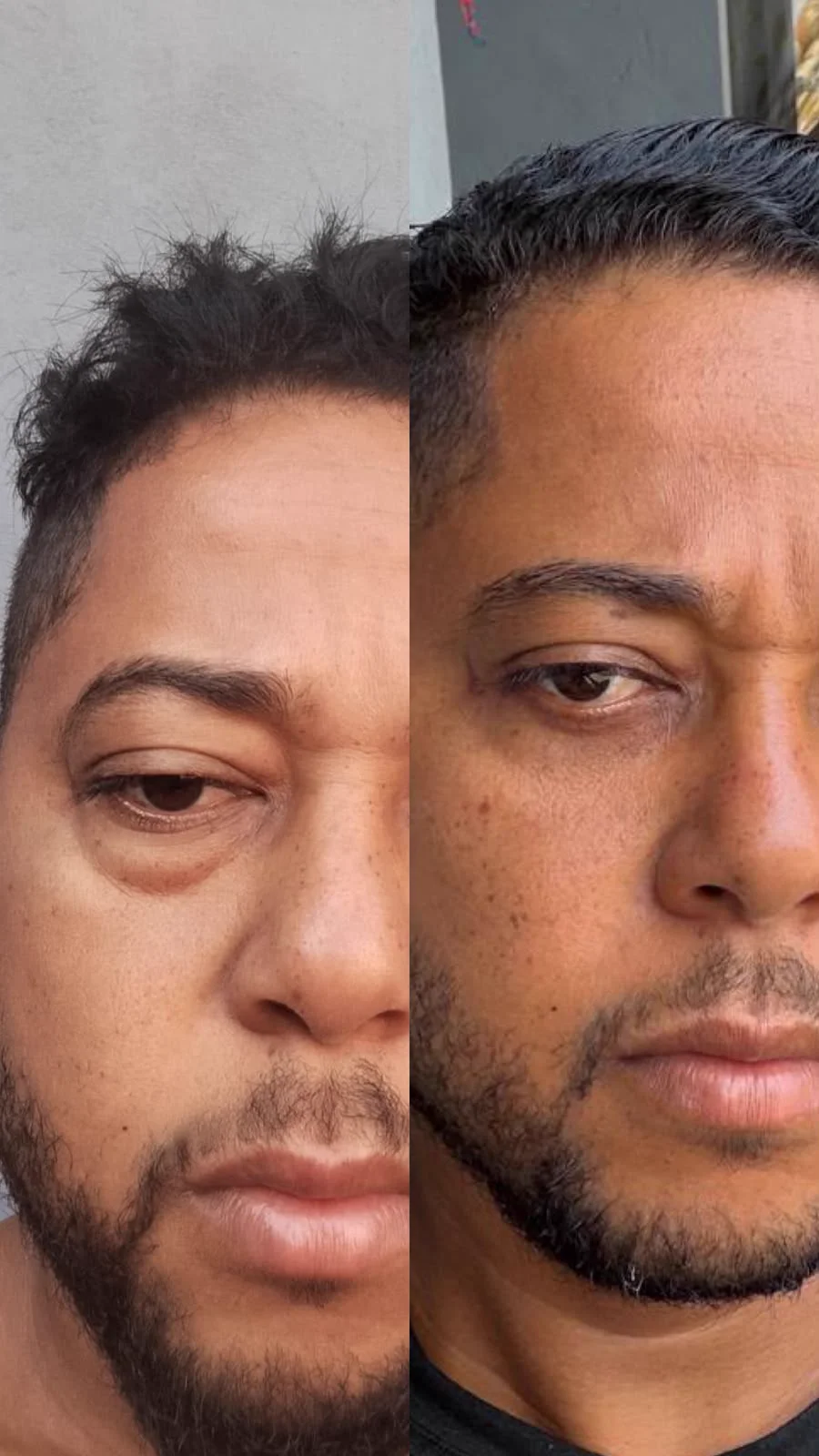 Blefaroplastia, antes e depois