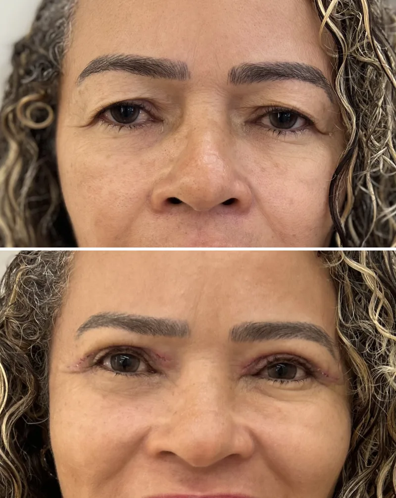 Blefaroplastia superior, antes e pós-operatório recente