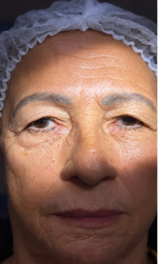 Blefaroplastia superior, antes