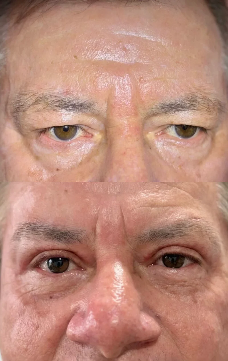 Blefaroplastia em paciente masculino, antes e um mês depois da cirurgia