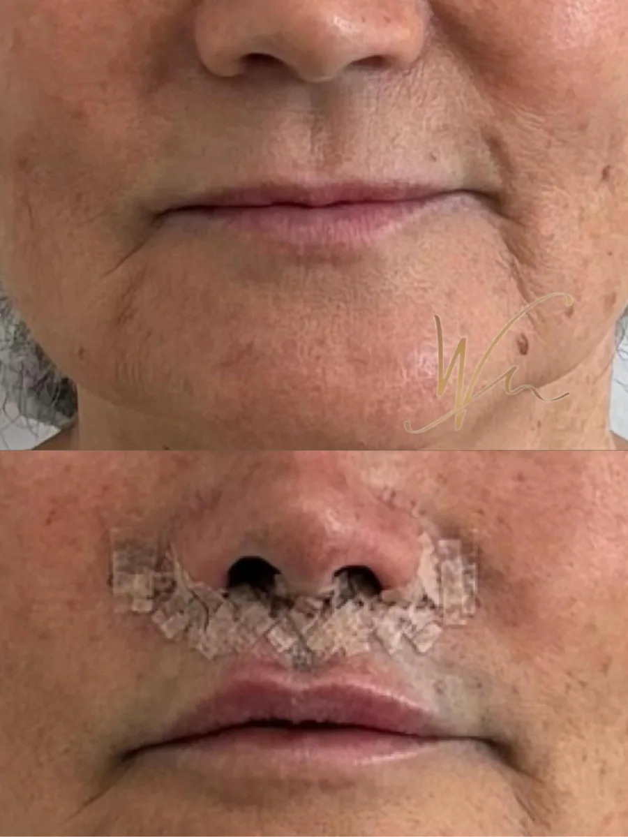 Lip lift, antes e pós imediato