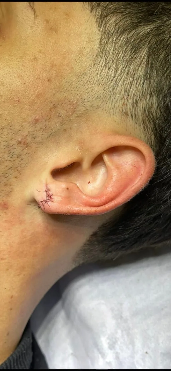 Lobuloplastia, pós imediato