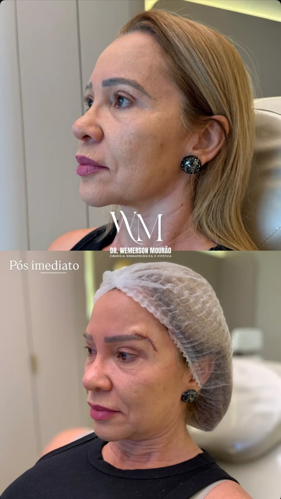 Lift de supercílios, antes e pós imediato
